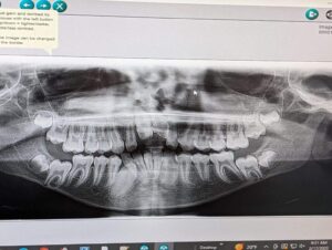 An X-Ray of Aleck's Teeth