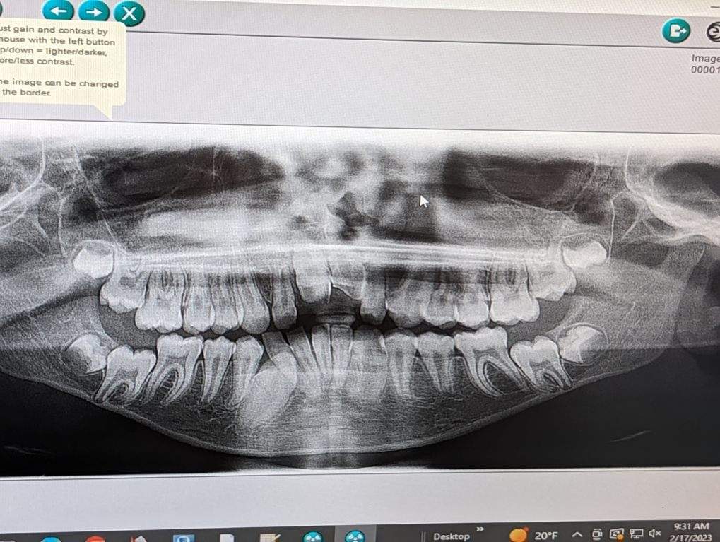 An X-Ray of Aleck's Teeth
