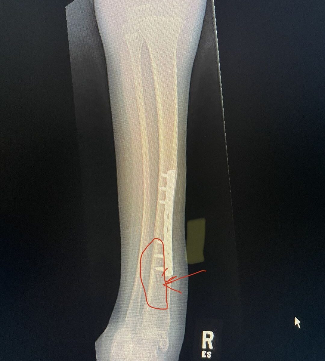 X-Ray of Aleck's hairline fracture in his tibia.