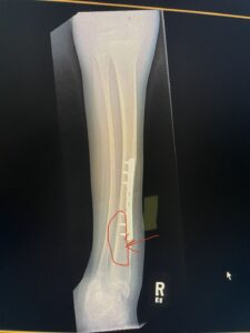 X-Ray of Aleck's hairline fracture in his tibia.